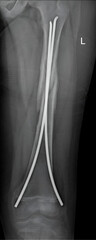  X-ray reveals a femur shaft fracture, capturing the site and extent of the break in the long bone...