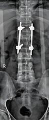 X-ray provides a detailed view of the lumbar spine, specifically focusing on the vertebrae that have undergone fracture fixation.
