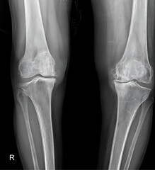  X-ray showcasing advanced osteoarthritic changes in the knee joint, including joint space narrowing and osteophyte formation. This image is invaluable for orthopedic research.