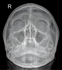 This frontal view of the paranasal sinuses highlights opacification and fluid levels indicative of...
