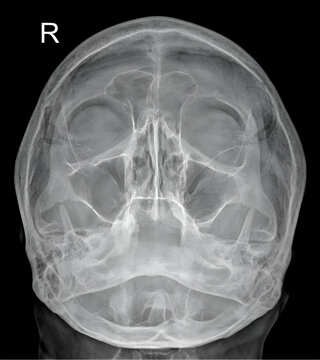 This frontal view of the paranasal sinuses highlights opacification and fluid levels indicative of sinusitis. An ideal image for otolaryngology publications, medical presentations.