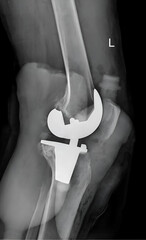 X-ray captures the transformative outcome of a knee joint replacement, showcasing the precision and success of orthopedic intervention. The image reveals the implantation of an artificial knee joint.