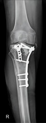 This striking X-ray provides a detailed view of a tibial plateau fracture, capturing the complexity...