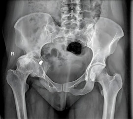  pelvic X-ray captures a complex fracture pattern, offering a comprehensive view of the pelvic girdle. 