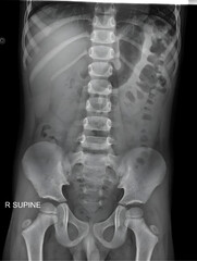 This pediatric abdominal and pelvic X-ray provides a comprehensive view of the young patient's...