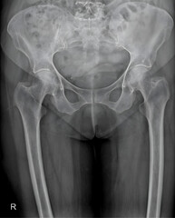 X-ray image of the female pelvis with proximal femurs