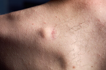 Small round lipoma on the upper back of young caucasian man. The lipoma is next to the scar left by a previous lipoma that became infected and dissolved - obrazy, fototapety, plakaty