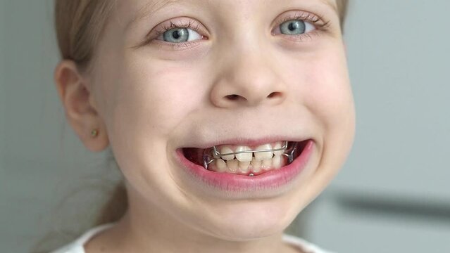 Lengthening the dentition and shifting teeth using removable orthodontic appliances. A child smiles widely with a plate in his mouth, Functional devices for aligning the bite in the mouth close-up