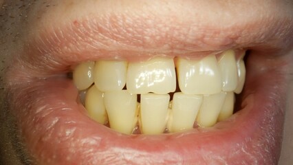 Teeth with tartar and caries, crooked lower foreground incisors, close-up