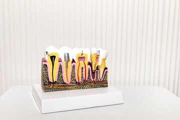 Dental Tooth Implant, Bridge Or Crown Model On White Background in Dental Office, Copy Space. Dummy...