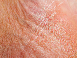 Dry skin damaged macro shot of the surface