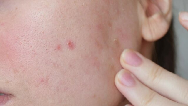 Close up skin with acne, peeling and enlarged pores. Dry skin with inflammation. Woman touching acne on her face. Skin problems, allergic, redness. Healing pimples. 4K Video