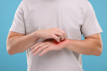 Allergy symptom. Man scratching his hand on light blue background, closeup