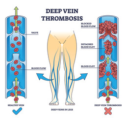 Deep vein thrombosis condition with blood clot blockage outline diagram. Labeled educational comparison with healthy vein and dangerous flow vector illustration. Cardiovascular disease explanation. - obrazy, fototapety, plakaty