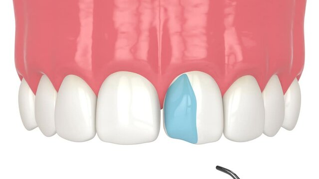 Crooked tooth treatment using bonding procedure with composite resin 