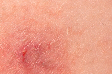 Close-up of a wound on the skin. Macro