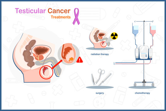 Testicular cancer treatment. Medical illustration vector concept in flat style of testicular cancer treatment includes surgery,chemotherapy and radiation therapy.