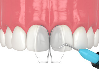 3d render of applying composite resin to close diastema