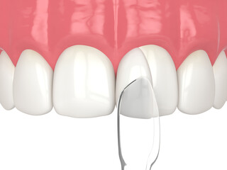 3d render of tooth reshaped by composite resin adm matrix over white. - obrazy, fototapety, plakaty
