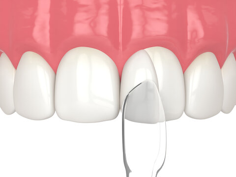 3d render of tooth reshaped by composite resin adm matrix over white.