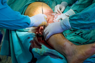 Orthopedic doctors carry out surgical procedures on leg to address patient a injuries.