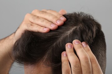 Fototapeta premium Man examining his head on light grey background, closeup. Dandruff problem