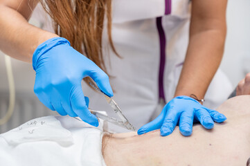 Nurse removing surgical stitches from the abdomen of a patient following surgical intervention. High quality photo