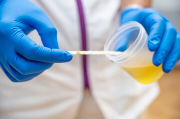 Close up of Nurse Hand holding urine sample container for medical urine analysis with color strip. High quality photo - obrazy, fototapety, plakaty