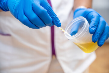 Close up of Nurse Hand holding urine sample container for medical urine analysis with color strip....