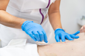 hand of Doctor is using clean cotton dressing infection wound at a man abdomen. Bandage for wound...