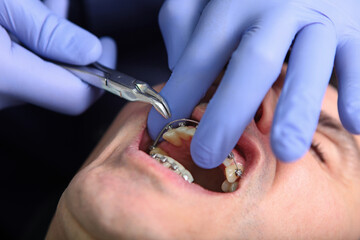 Braces on the teeth. Close-up of a dentist's hand with a tool. Correction of braces. Orthodontic...