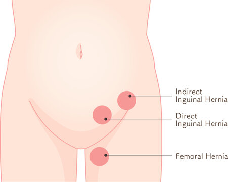 ヘルニア、鼠径ヘルニア、そけい、股関節、骨盤、筋肉、イラスト、illustration