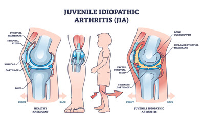 Juvenile idiopathic arthritis or JIA anatomical explanation outline diagram. Labeled educational medical scheme with healthy and diseased joint comparison vector illustration. Child bone illness.
