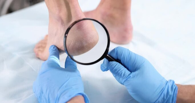 Doctor examining skin with cracks on heels of female patient using magnifying glass closeup 4k movie slow motion. Diagnostics and treatment of dry calluses of feet concept