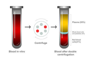 Glass medical test tube filled with blood in vitro and blood after double centrifugation, plasma and layers of red blood cells. Chemical glass in realistic style. Medical laboratory.