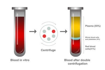 Glass medical test tube filled with blood in vitro and blood after double centrifugation, plasma and layers of red blood cells. Chemical glass in realistic style. Medical laboratory. - obrazy, fototapety, plakaty