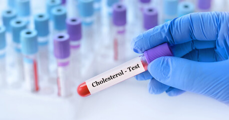 Doctor holding a test blood sample tube with Cholesterol test on the background of medical test...