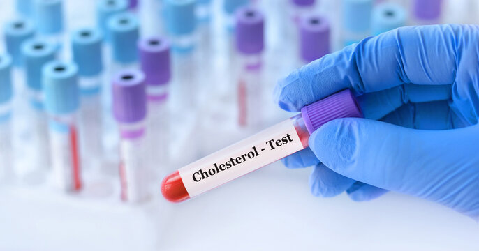 Doctor holding a test blood sample tube with Cholesterol test on the background of medical test tubes with analyzes
