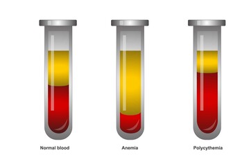 Blood inside a test tube with different concentrations of Hematocrit. Normal, Anemia and Polycythemia.Test tube with blood for education. Chemical glass in realistic style. Medical laboratory.
