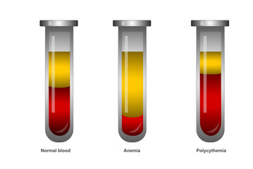 Blood inside a test tube with different concentrations of Hematocrit. Normal, Anemia and Polycythemia.Test tube with blood for education. Chemical glass in realistic style. Medical laboratory.