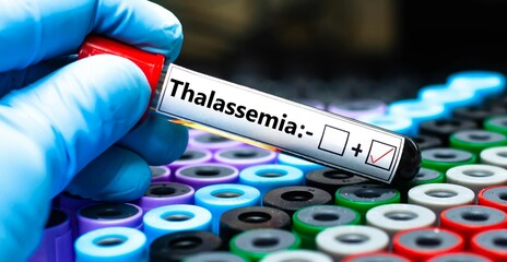Blood sample of patient positive tested for thalassemia.