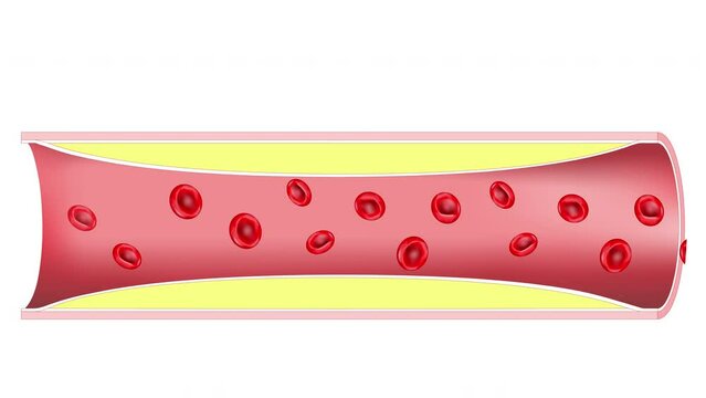 Atherosclerosis. Plaque formation