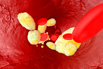 3D Rendered illustration, visualisation of fat clogging a artery and forming the sickness...