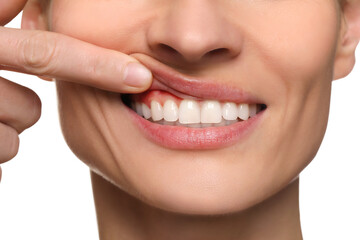 Woman showing inflamed gum on white background, closeup