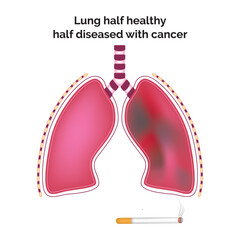 Lung Half Healthy Half Diseased With Cancer Science Design Vector Illustration