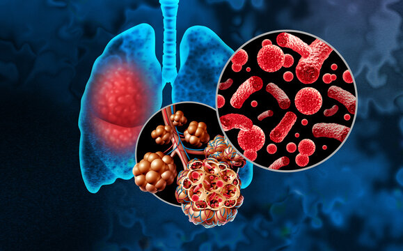 Bacterial Pneumonia or Pneumonia In the Lungs and Pulmonary alveoli with fluid or alveolus inflammation anatomy diagram as a medical concept of a lung and respiratory disease