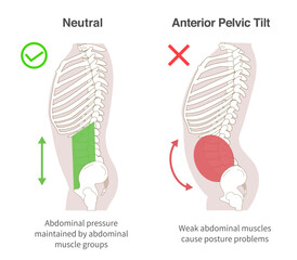 Diagrammatic illustration of the relationship between abdominal muscle groups, abdominal pressure, and Anterior Pelvic Tilt in sideways