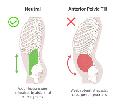 Diagrammatic illustration of the relationship between abdominal muscle groups, abdominal pressure, and Anterior Pelvic Tilt in sideways