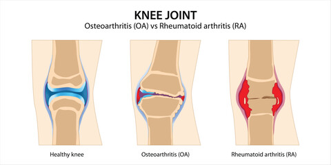 Knee Joint Osteoarthritis vs Rheumatoid arthritis - obrazy, fototapety, plakaty