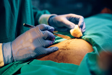 Close up of surgeon using scalpel while making incision on patient's abdomen in operating room. - obrazy, fototapety, plakaty